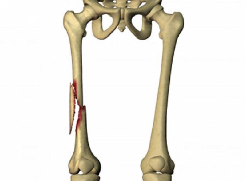 Перелом бедренной кости. Бедренная кость перелом. Перелом тела бедренной кости. Переломы бедренной кости кости. Бедренная кость надлом.