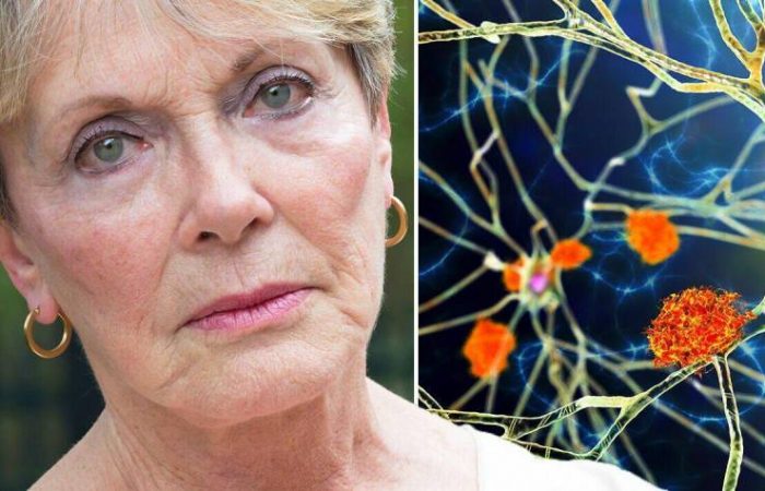 Без симптомов: возможно ли бессимптомное развитие болезни Альцгеймера?