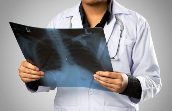 Зазор между пальцами: простой тест на рак легких